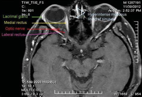 Radiology Anatomy Images : Orbit MRI Anatomy