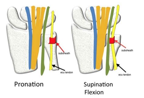 Snapping Extensor Carpi Ulnaris (ECU) - Hand - Orthobullets