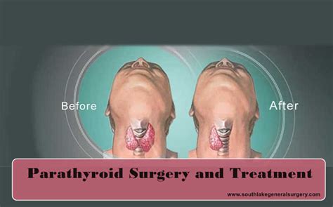 Parathyroid Disease Symptoms And Treatment