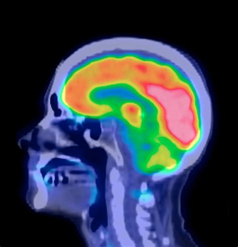 Human brain, PET scan - Oxford University Innovation