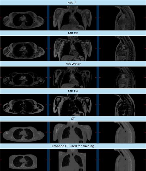 Axial, coronal, and sagittal planes (from left to right) showing, for ...