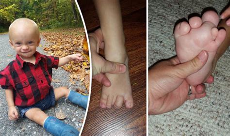 Baby with Proteus Syndrome: Poor toddler's feet can't stop growing ...