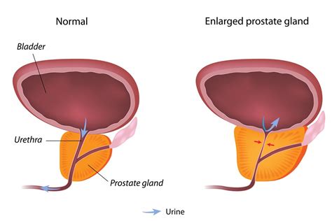 Benign prostate enlargement - NHS