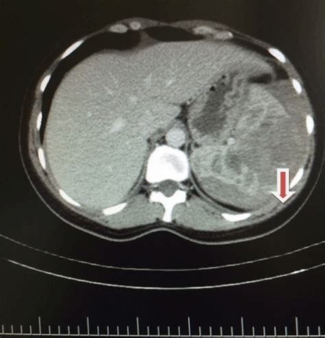 FULL TEXT -Spontaneous splenic rupture without trauma: A case report ...