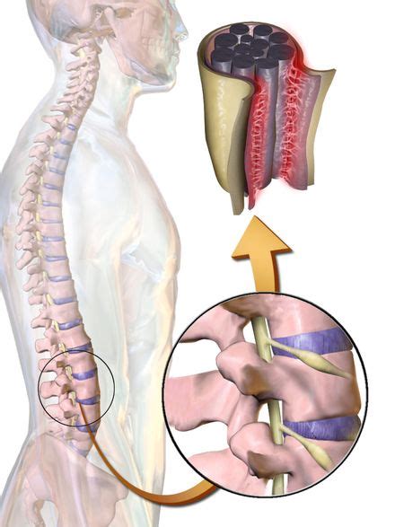 Arachnoiditis - Wikipedia, the free encyclopedia Chronic Fatigue ...