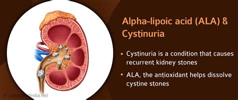 Alpha-lipoic Acid Prevents Kidney Stones in Rare Genetic Disease