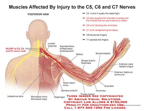 (13128_03X) Muscles Affected by Injury to the C5, C6, and C7 Nerves – Anatomy Exhibits