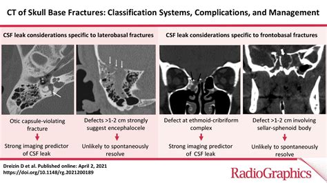 Skull Base Fracture