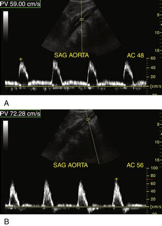 Ultrasound Assessment of the Abdominal Aorta | Radiology Key