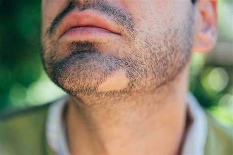 Cardiac, Metabolic Morbidity Highly Prevalent in Patients with Alopecia Areata - Dermatology Advisor