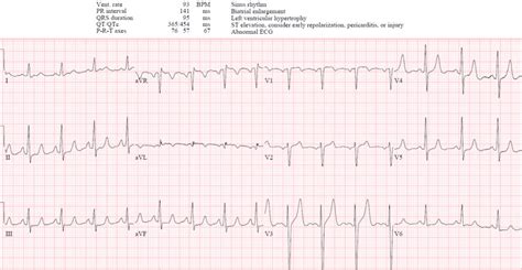 Hyperacute T waves and Occlusion MI | ECG Cases| Emergency Medicine Cases