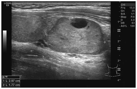 Surgical treatment of primary hyperparathyroidism due to parathyroid tumor: A 15-year experience