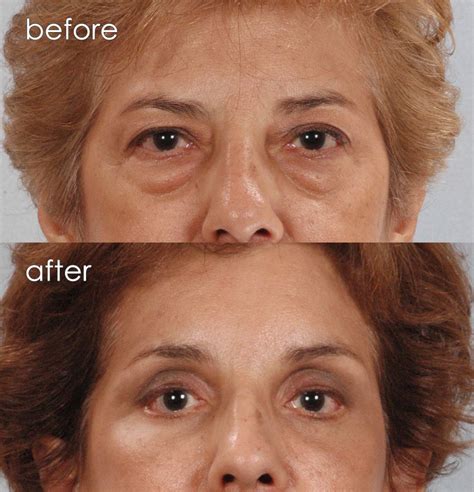 How to Make Bags Under Eyes Disappear in 60 Seconds - Healthy Beauty, Health And Beauty Tips ...