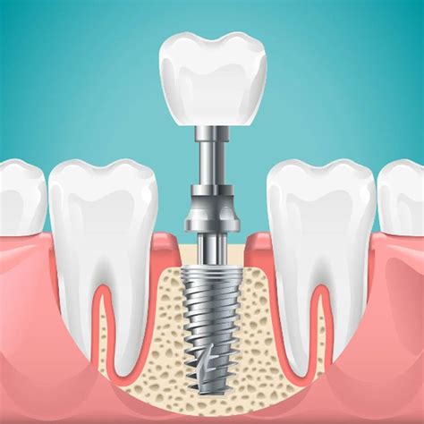 Premier Dental Implants Clinic In Hyderabad & Bangalore