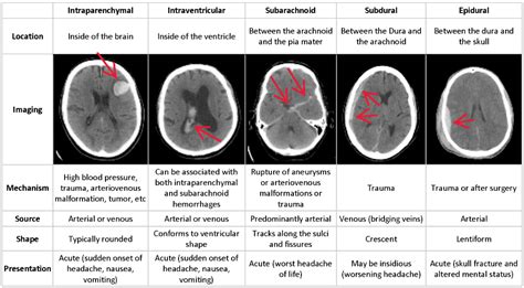 Intracranial Haemorrhage Detection using Deep Learning | by Gopal B ...