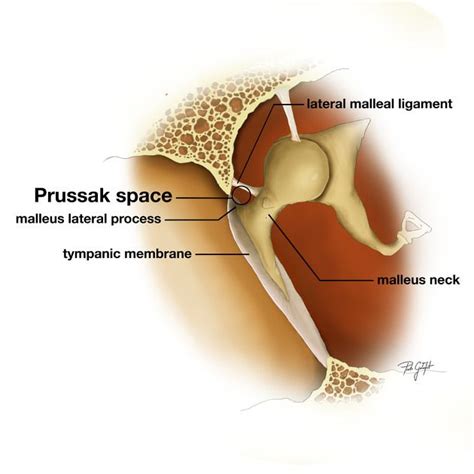 Prussak space | Radiology Reference Article | Radiopaedia.org | Radiology, Medical anatomy, Ear ...