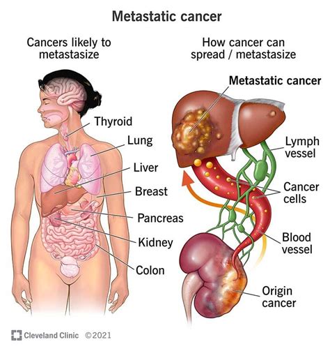 Breast Cancer Metastasis To Liver Symptoms