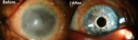 Cornea transplant types, success rate, vision after transplant ...