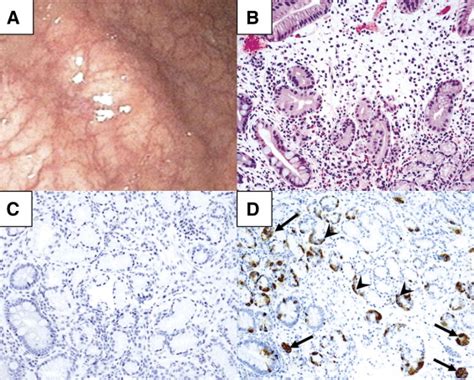 Review of autoimmune metaplastic atrophic gastritis - Gastrointestinal Endoscopy