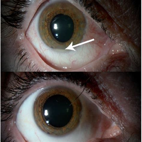 (PDF) Hypopyon Uveitis Following Panretinal Photocoagulation in a Diabetic Patient