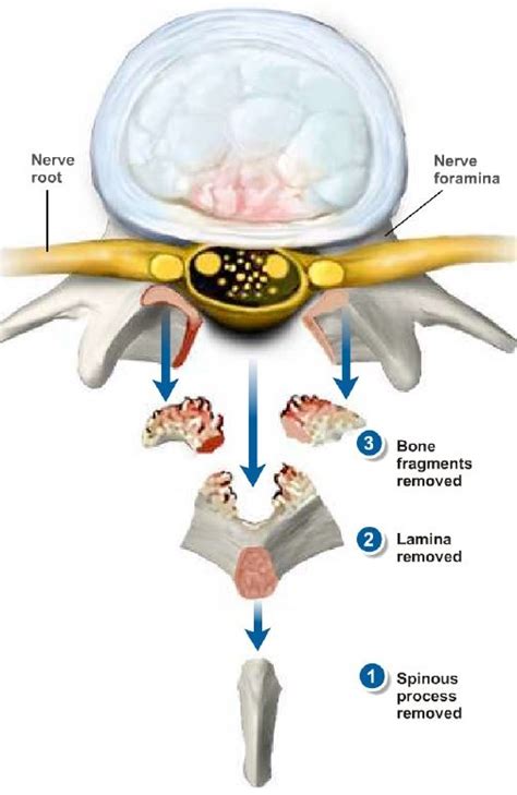 Lumbar Laminectomy | Dr. Paul Jeffords, MD