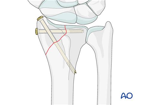 Radial Styloid Fracture Splint