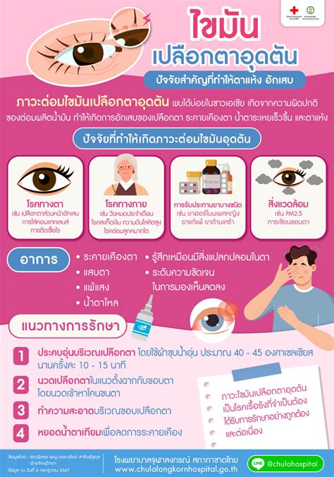 Understanding Meibomian Gland Dysfunction: Causes, Signs, and Therapy ...