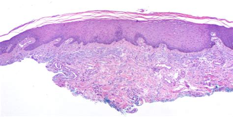 Labial Lentigo (labial melanotic macule) - Dermatology Advisor