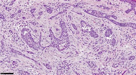 Morpheaform Basal Cell Carcinoma Histology