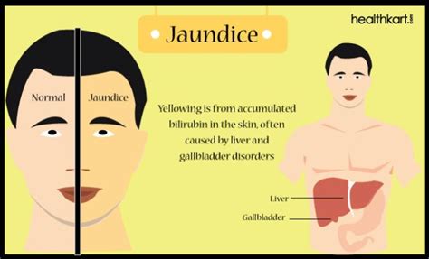 How to deal with Jaundice symptoms? - HealthKart