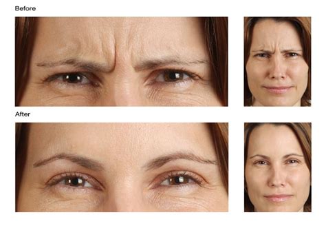 Frown Lines in Dublin cosmetic clinic – Castleknock Cosmetic Clinic