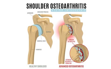 Shoulder Osteoarthritis Treatment | Melbourne Hand Therapy