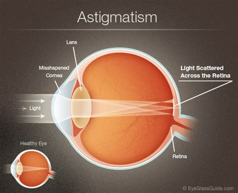 How to treat Cylinder Number (Astigmatism) in Eyes