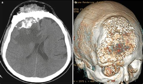 Meningioma | Radiology Key