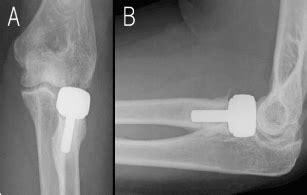 Artificial radial head replacement for Mason type Ⅲ comminuted fracture