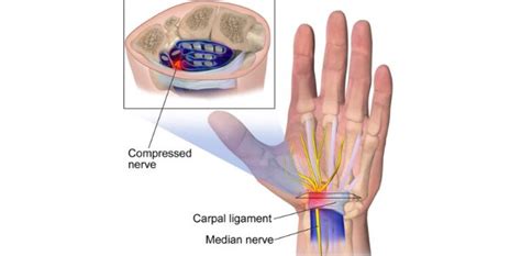 5+ Wrist Pain Exercises To Relieve Pain and Prevent Injury