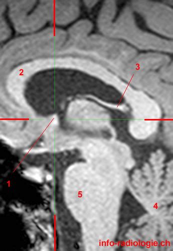 Fornix of the Brain - W-Radiology