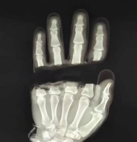 Doctors sew man's fingers back on after he severed all four with a power tool | Metro News