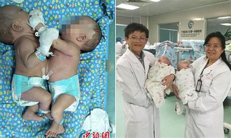 Chinese twins conjoined at the abdomen are separated | Daily Mail Online