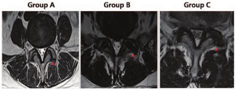 Grading of facet joint osteoarthritis in representative T2-weighted... | Download Scientific Diagram