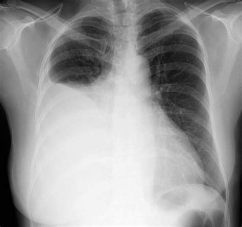 รายการ 98+ ภาพ Pleural Effusion พยาธิสภาพ อัปเดต