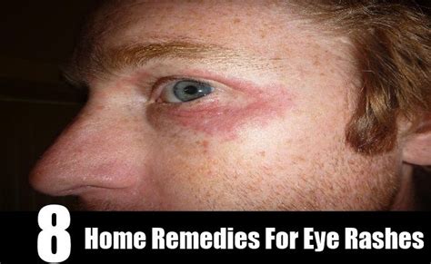 8 Home Remedies For Eye Rashes | Home remedies, Severe itching, Remedies