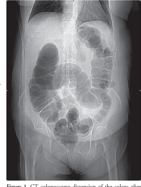 Figure 1 from COMPUTED TOMOGRAPHY COLONOGRAPHY - THE PROCEDURE IN OUR DAYS. LITERATURE REVIEW ...