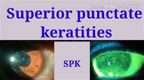 Superficial Punctate Keratitis Spk