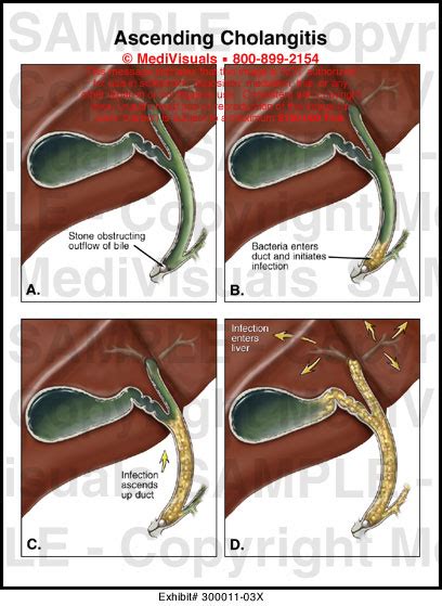 Ascending Cholangitis Medical Illustration Medivisuals