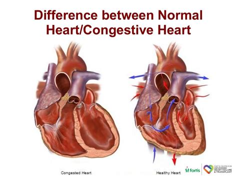 Advanced heart-failure-treatment-options