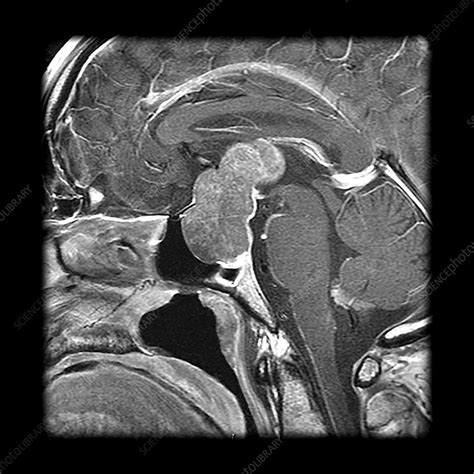 MRI Pituitary Macroadenoma - Stock Image - C043/3144 - Science Photo ...