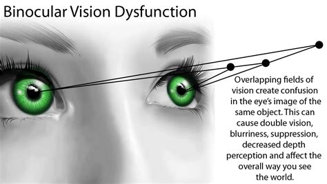 Binocular vision dysfunction/ BVD- Headache inspite of Correct glass prescription. - An Eye Care ...