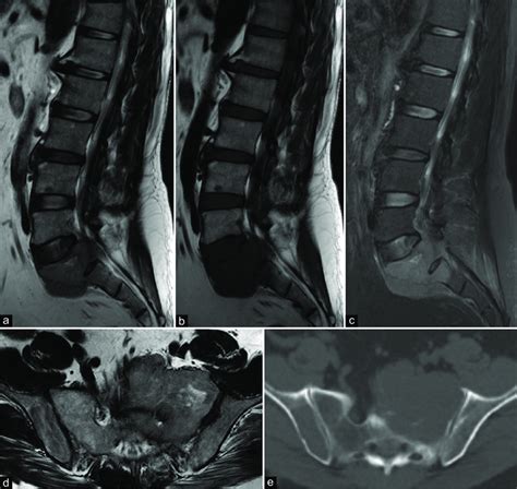 Preoperative sagittal magnetic resonance images (MRI) enhanced in T2... | Download Scientific ...