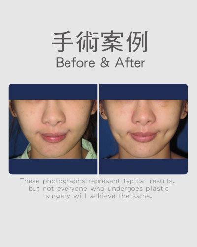 Philtrum Reduction-Facial Surgery | Wish Aesthetic Surgery Clinic